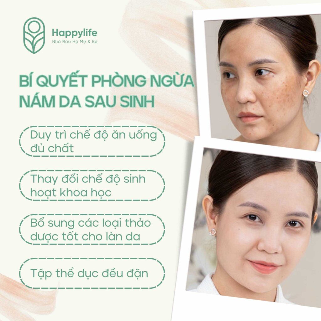 Bí quyết phòng ngừa nám da sau sinh